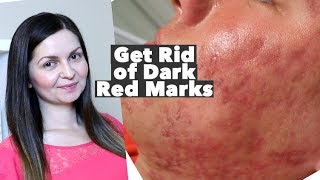 How to Get Rid of Red Acne Marks – Hyperpigmentation  Post Inflammatory Erythema – PIE vs PIH