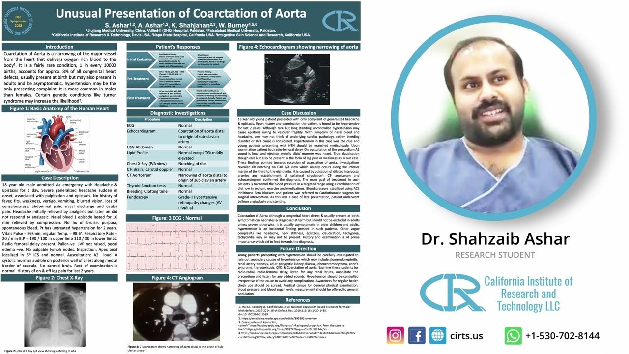 Unusual Presentation of Coarctation of Aorta - Dr. Shahzaib Ashar