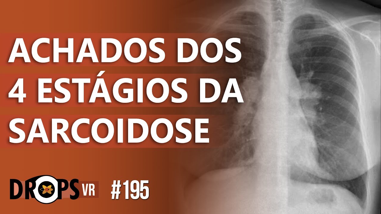 ACHADOS DOS 4 ESTÁGIOS DA SARCOIDOSE NA RADIOGRAFIA