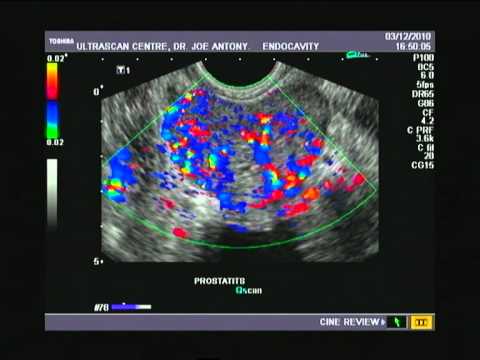 Gute Antibiotikum für die Behandlung von Prostatitis Kolik von Prostatitis