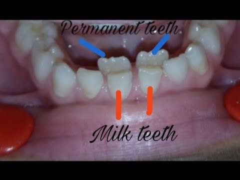 Over retained deciduous teeth/ milk teeth extraction || dental issues