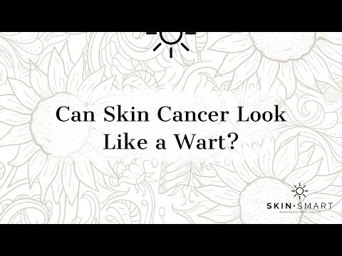 Can skin cancer look like a wart?