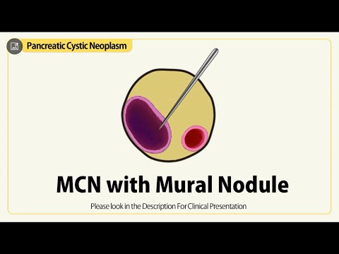 Linear EUS: MCN with Mural Nodule