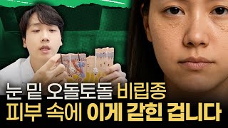 눈 밑에 비립종 왜 생길까? 집에서 제거 가능? 깨끗한 눈가피부 만들기
