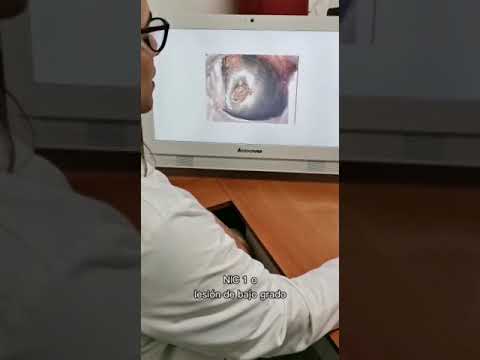 Lesiones VPH en Cérvix