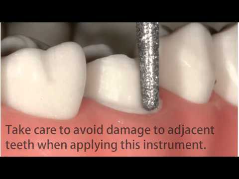 How to Complete Lateral-Crown Preparations with Expert Kit 4573ST