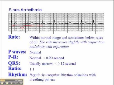 ECG: Sinus Arrhythmia