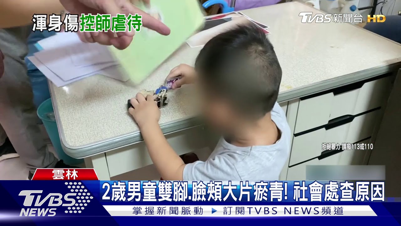 2歲男童雙腳、臉頰大片瘀青! 社會處查原因