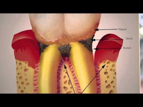 วิธีแก้ปวดฟัน
