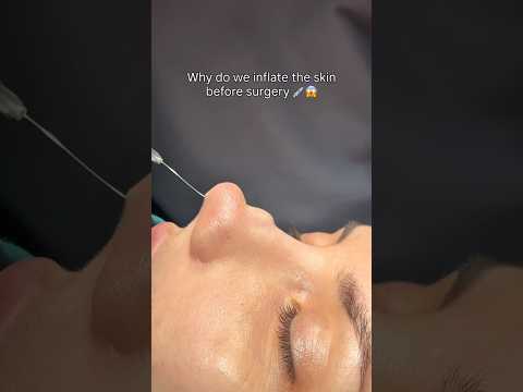 Hydrodissection 💉 #rhinoplasty #nose #surgery #asmr #satisfying