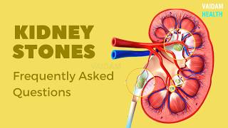Kidney Stones- Frequently Asked Questions