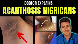 Doctor explains Acanthosis Nigricans - signs, symptoms, causes, treatment and more!