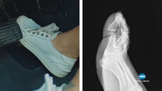Visualizing Foot Mechanics with Dynamic Digital Radiography (DDR) | Konica Minolta Healthcare