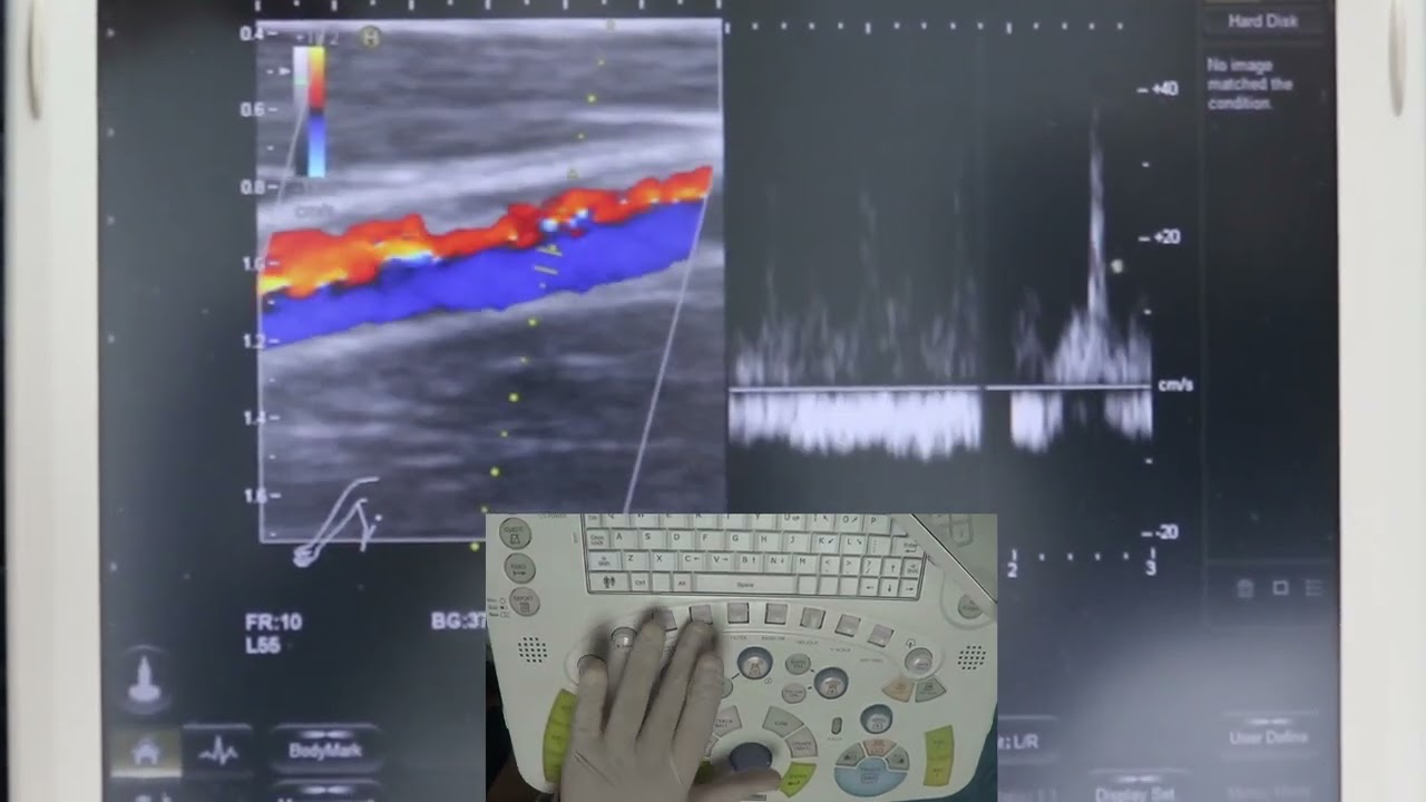 Sample Volume : Doppler basics