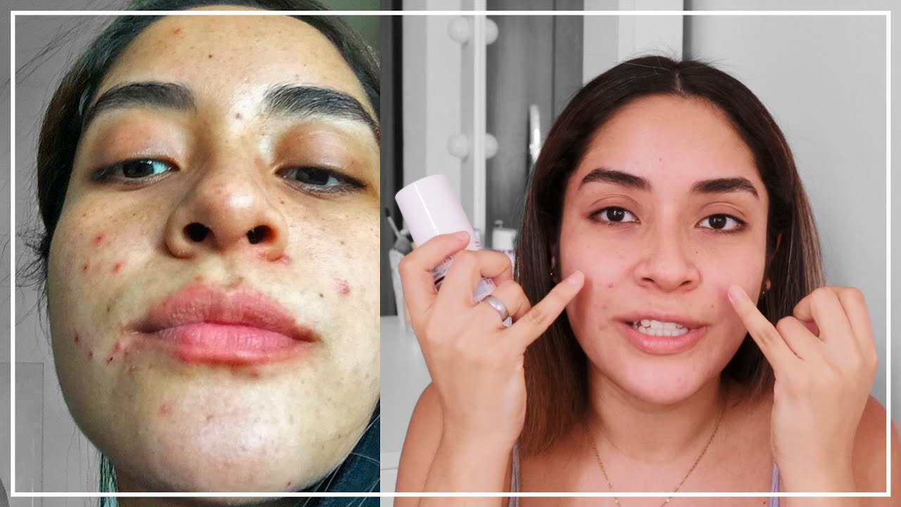 PRIMER MES CON TRATAMIENTO ANTI ACNÉ (Con Epiduo Gel) | Gabcamva