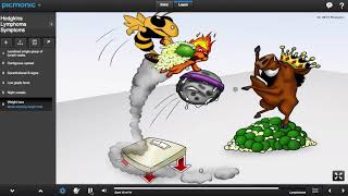 Hodgkins Lymphoma Symptoms