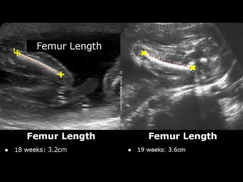Femur Length Ultrasound Normal Values | Femoral Length Measurements | Fetal Biometric Parameters USG