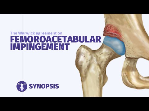 Femoroacetabular Impingement (FAI) Syndrome | SYNOPSIS