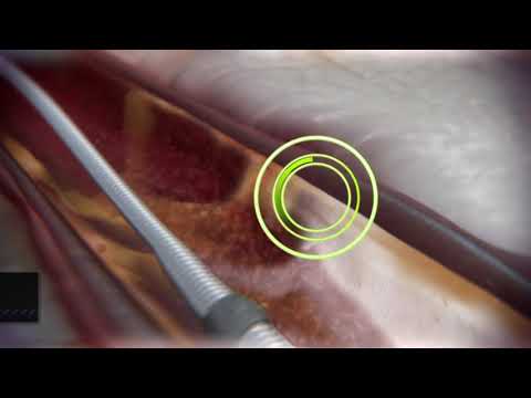 Coronary Orbital Atherectomy (Long video)