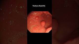 Download lagu Ini yang terjadi pada lambung saat kita makan makanan pedas #gastritis #asamlambung #makananpedas mp3 Download lagu Ini yang terjadi pada lambung saat kita makan makanan pedas #gastritis #asamlambung #makananpedas mp3