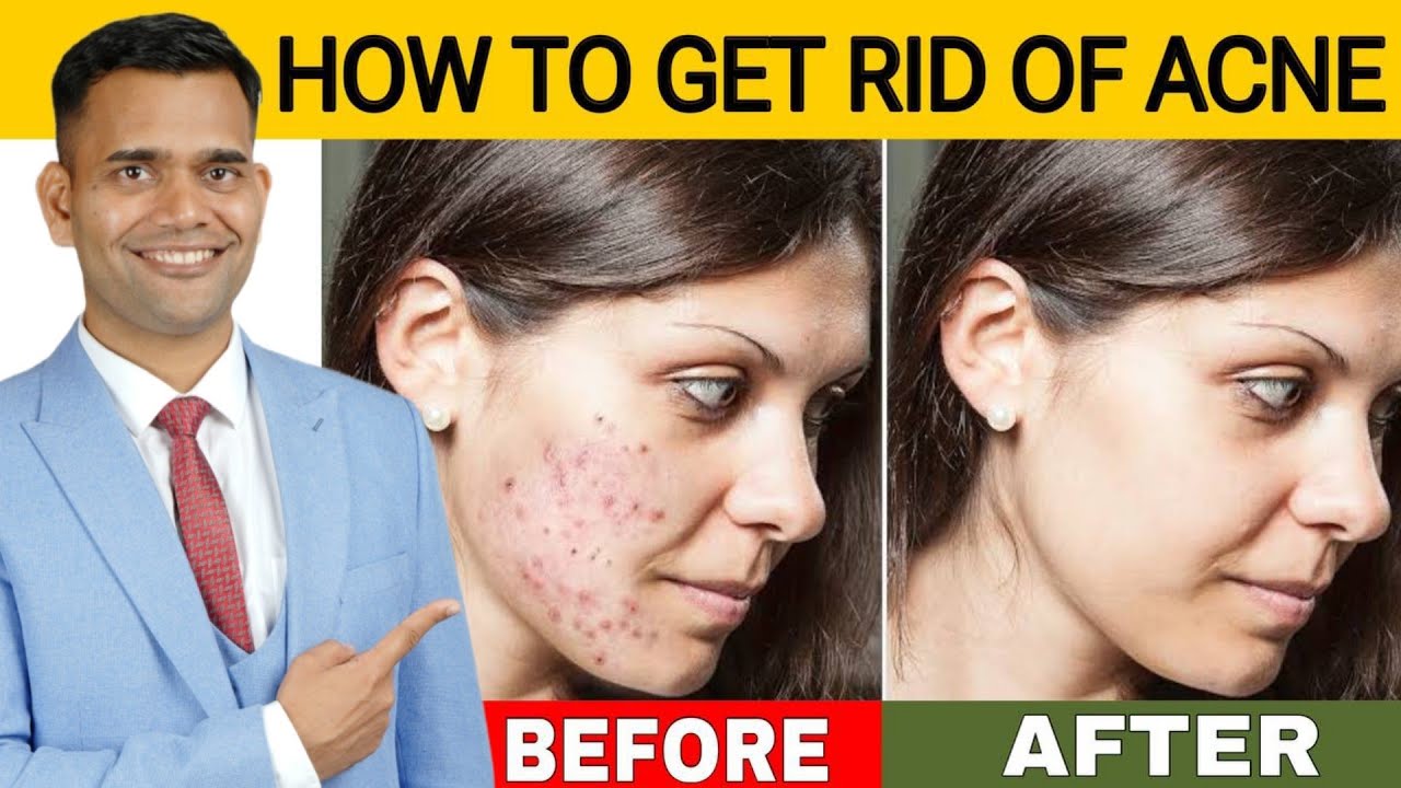 How To Remove Acne From Face Fast Naturally | Get Clear Spotless Glowing Skin - Dr. Vivek Joshi