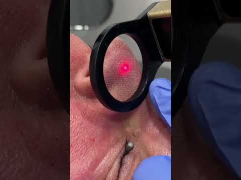 CO2 LASER FOR ENLARGED PORES | DRMEDISPA