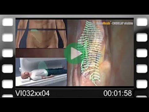 DynaMesh®-ENDOLAP visible - Animation: MRI visible - 3D Implant Remodelling