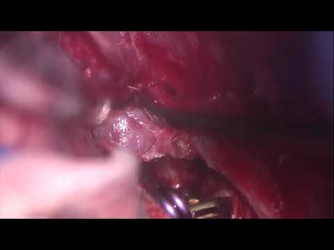 Video thumbnail for Clipping of unruptured pericallosal aneurysm