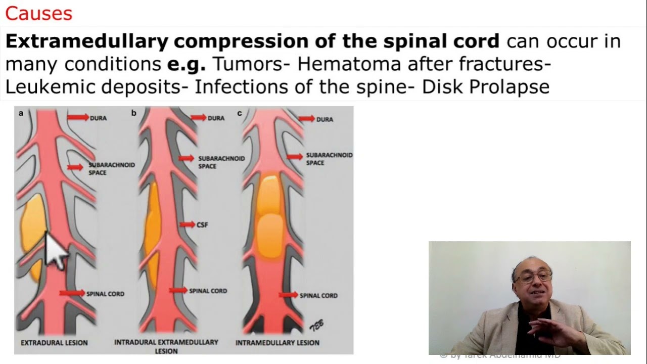Spinal Cord Compression (Extramedullary lesions)