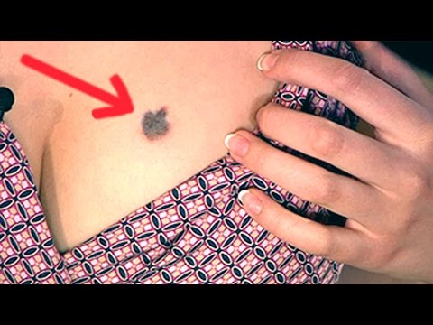 Лазерное удаление пигментных пятен в краснодаре отзывы Темное шелушащееся пятно на лице