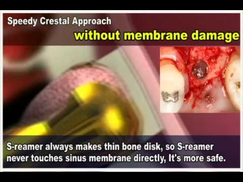 SCA Kit Display animation