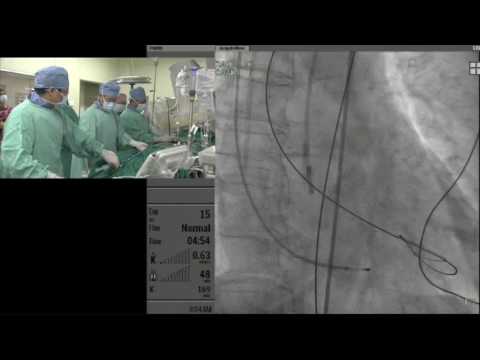 AP VALVES 2016_Live Case Session I