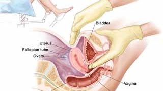 Cervical Cancer & its Treatment Video | How to Treat Cervical Cancer