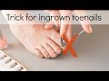 How To Fix Ingrown Toenails Easily