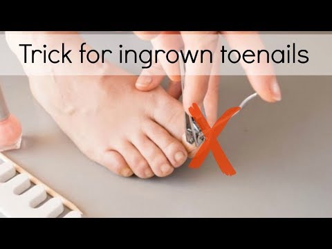How to Fix Ingrown Toenails Easily