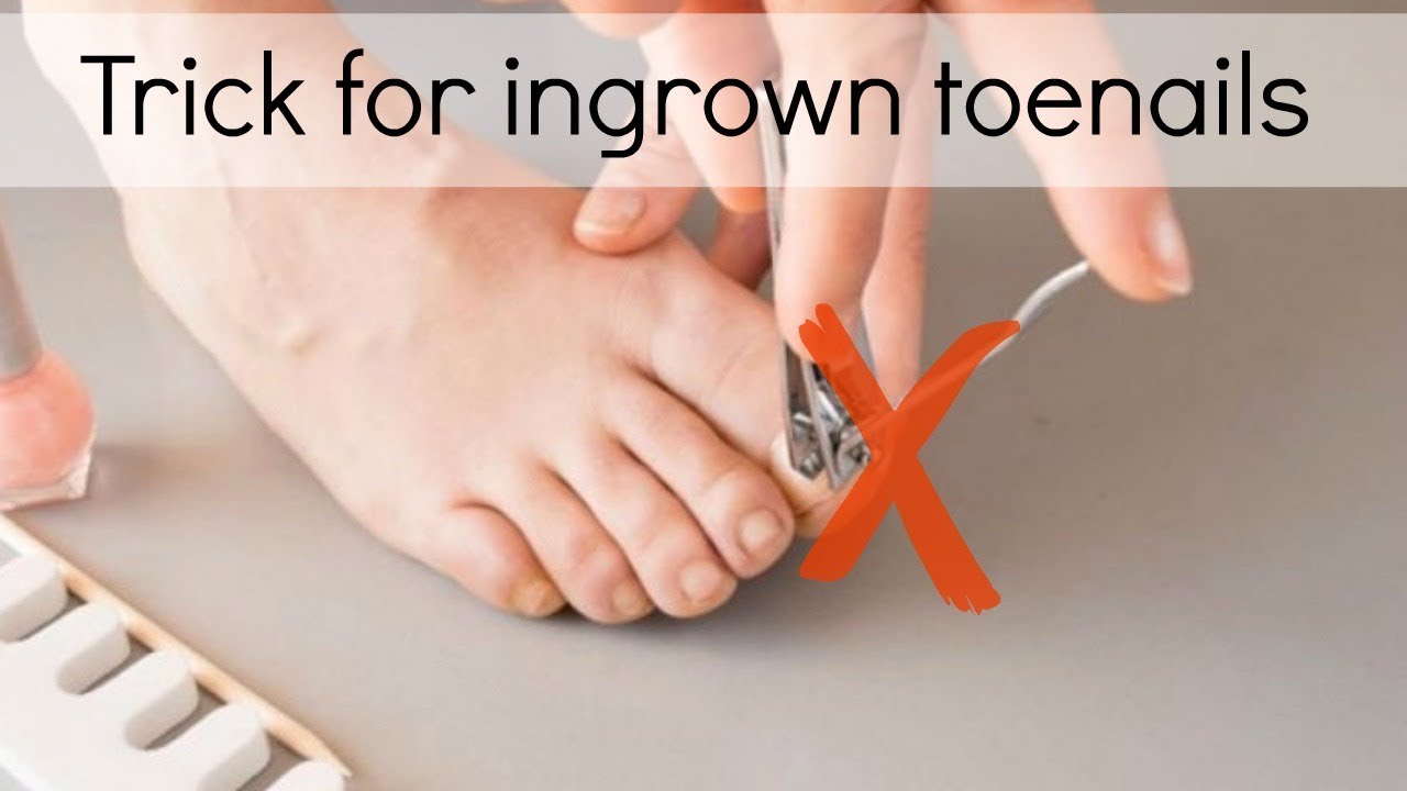 How to Fix Ingrown Toenails Easily