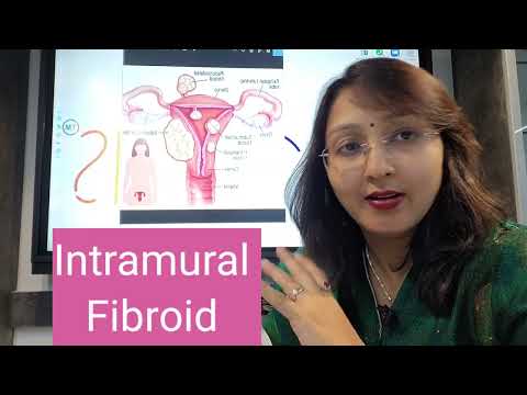 FIBROID UTERUS - Intramural / Subserosal / Submucosal