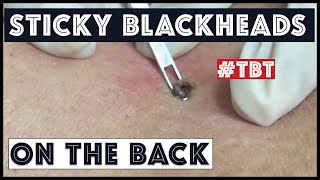 Big Blackheads on the Back, Extracted: The Sticky Ones.  A TBT!