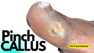 The Pinch Callus: Removal of a Common Foot Problem