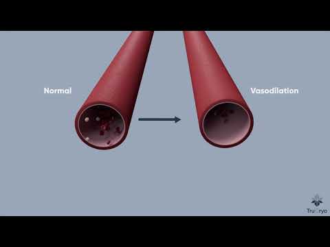 Criolipolisis con Kaasen