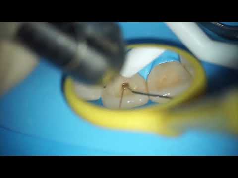 Laser assisted endodontics