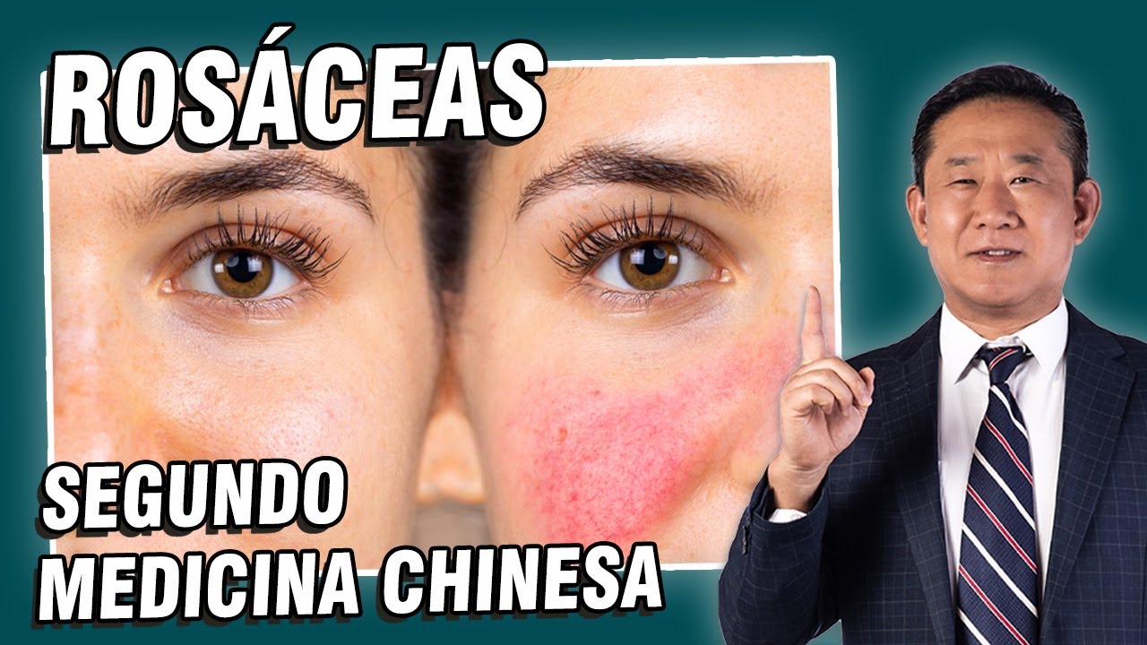 O que é a ROSÁCEA e como tratar a vermelhidão no rosto | Peter Liu