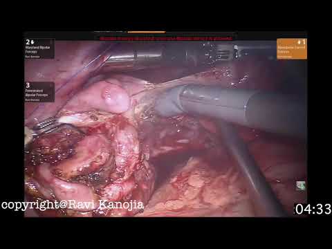 Large Choledochal Cyst with Minimal Access Approach with Robot and Laparoscopy