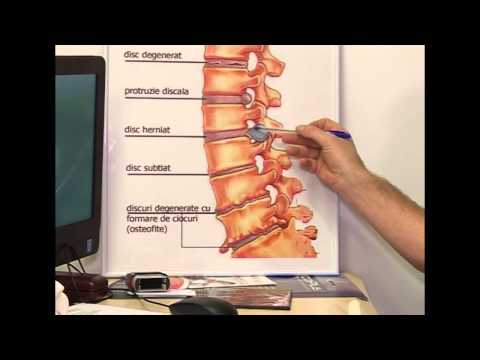 Osteoartroza tratamentului articulației gleznei de gradul 3