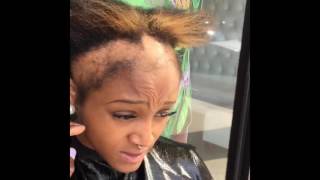 GIRL SUFFERING FROM SEVERE HAIRLOSS DUE TO BRAIDS, SEW-INS QUICK WEAVES