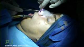 Dr. Nassif’s Closed Rhinoplasty How To – Exposing Nasal Skeleton
