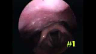 Feminization Laryngoplasty 2005 Bologna