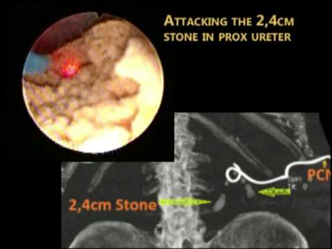 Antegrade Flexy Ureteroscopy