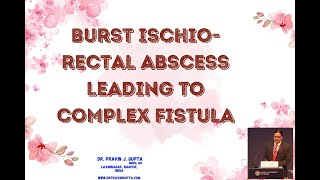 Download Lagu गुदा की गांठ फिस्चुला कैसे बनती है BURST ISCHIO-RECTAL ABSCESS LEADING TO COMPLEX FISTULA Thumbnail