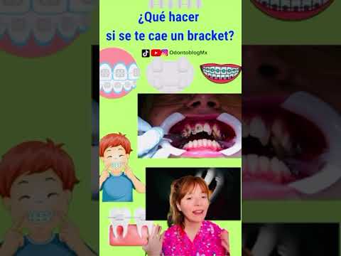 ¿Qué hacer si se te cae un bracket?